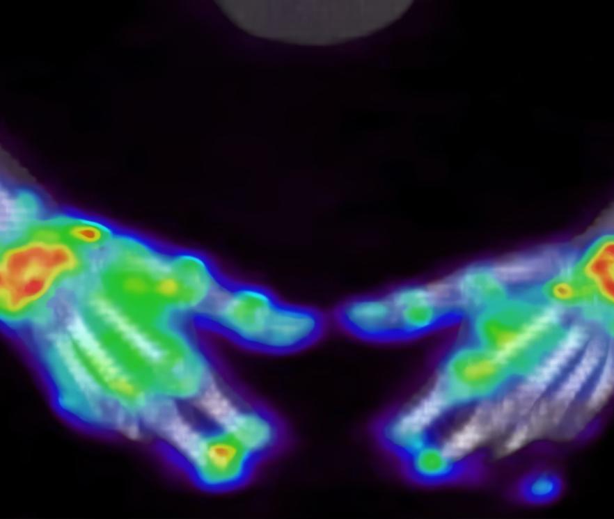 PET-Scan