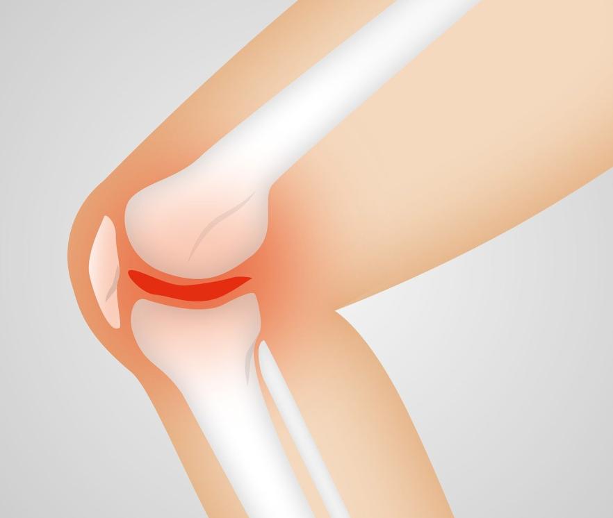 arthrocalman-2384254_1280