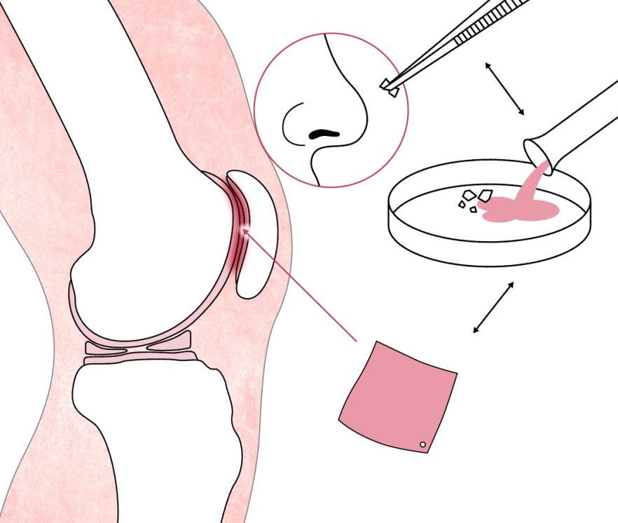Neuskraakbeen bij artrose achter de knieschijf